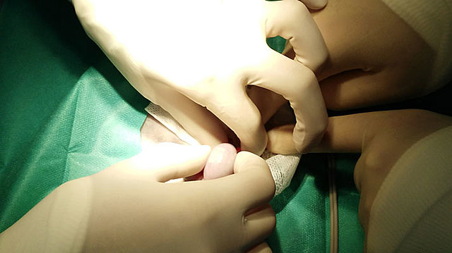 Primera ovariectomía exitosa contra Cáncer de ovarios