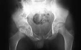 La era moderna (la cirugía ortopédica y traumatológica en el siglo XX)