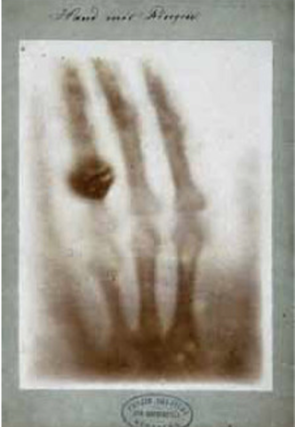 Primera radiografia realizada por Roentgen