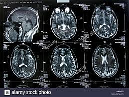 Tomografía Axial  Computarizada
