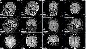Resonancia magnetica nuclear