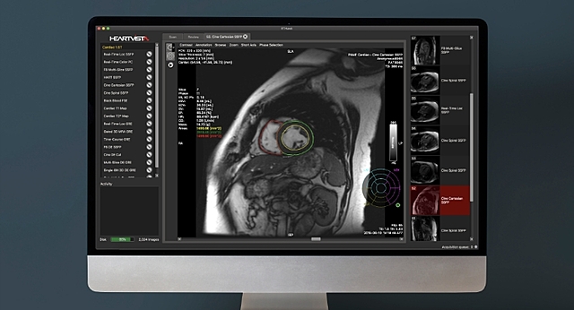 La FDA aprueba el primer algoritmo de Inteligencia Artificial usando MRI