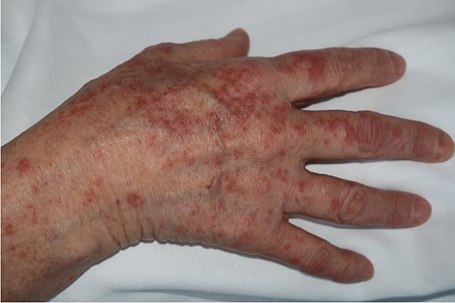 1951 Evento 4 Comite  Internacional de Proteccion Radiologica