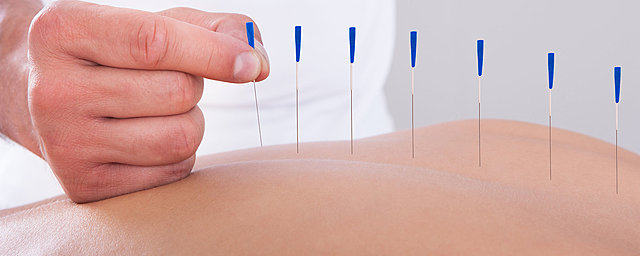 Acupuntura