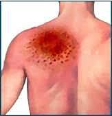 Quemaduras causadas por los rayos X.