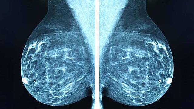 La primera mamografia digital