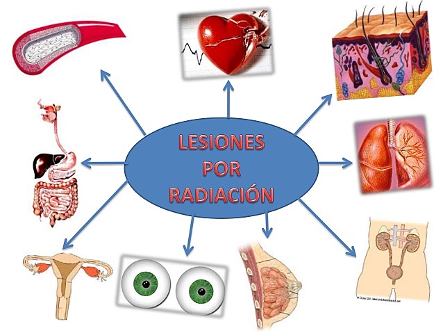 Canceres por radiación