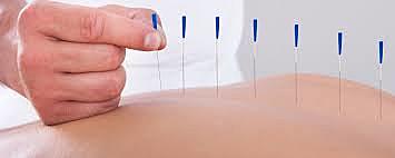 Medicina Tradicional Acumputura