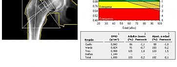 Densitometría Ósea
