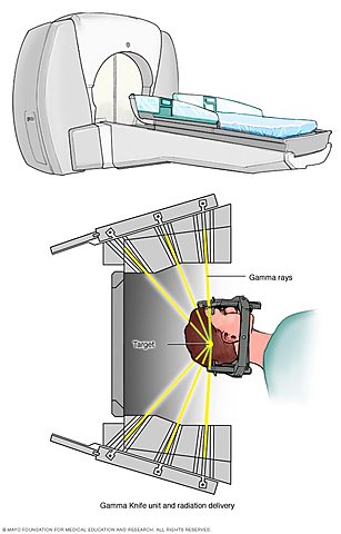Radiocirugía estéreotactica