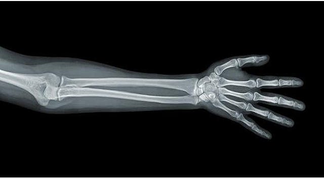 Tomografia de Brazo Fracturado