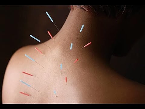 Acupuntura