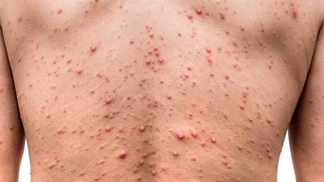 Fritz Schoudinn y Erich Hoffmann