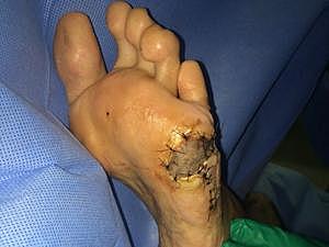 pé preto contagioso cuidado