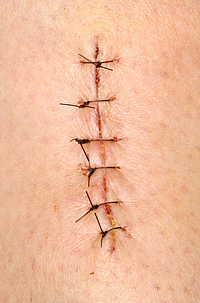 Got stiches  in knee