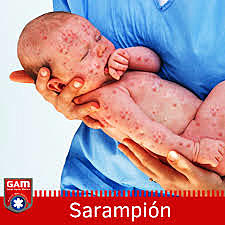 La vacuna contra el sarampión