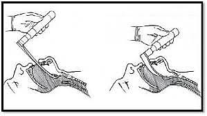 antecedente mejor documentado sobre la intubación traqueal