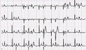 Invention of the Electrocardiograph