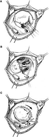 First successful heart valve repair surgery