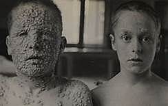 Plan erradicación viruela