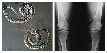 Programa erradicación de la Dracunculosis