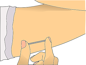 Implante anticonceptivo