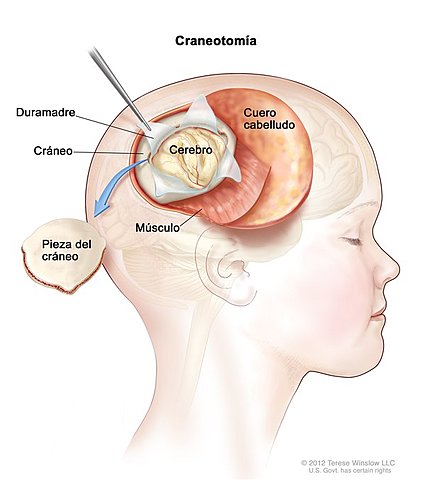 Craneotomía