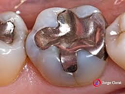 Amalgama dental.
