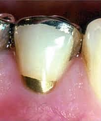 Lamina de oro cohesiva