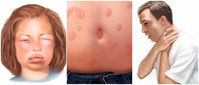 C. Richet Trabajo sobre la anafilaxia