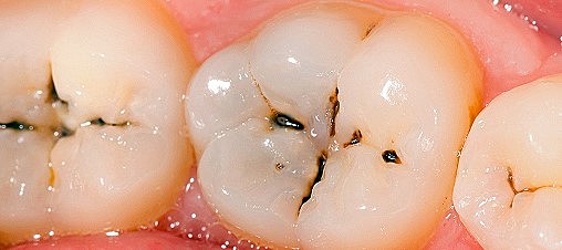 Teoría de las caries dentales.