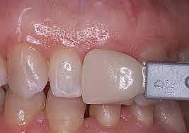 Silicato en odontología estética