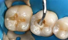 Ionómero de vidrio en odontología