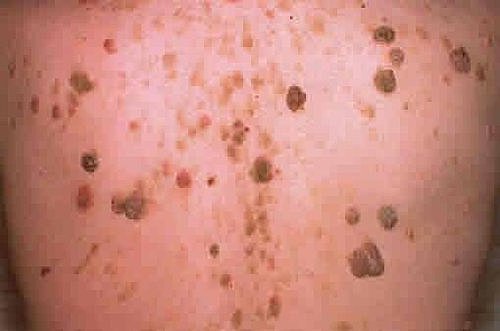 Trabajos de la fiebre tifoidea