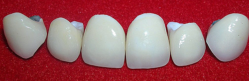 Las primeras coronas jacket de porcelana