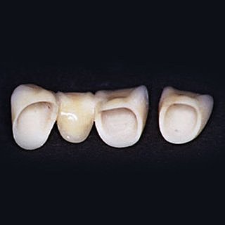Vita In-Ceram alumina
