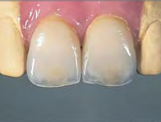 Vita In-Ceram spinell