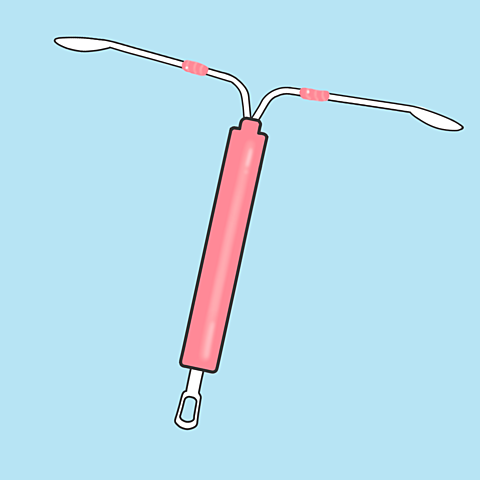 Dispositivo intrauterino (DIU) de cobre