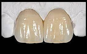 Introducción de la cerámica como material restaurador