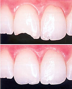 Innovación de Resina