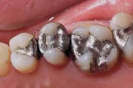 Principios del uso de amalgama