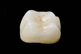 Primera corona de ceramica