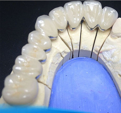 Carillas de porcelana