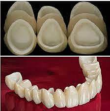 Restauraciones de ceramica sin metal