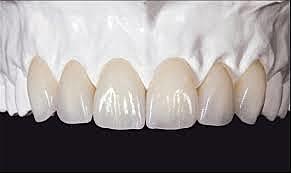 Introducción de In-Ceram Zirconia