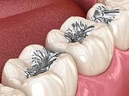 Comienzo de la amalgama dental