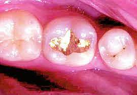 Arthur descubre una lámina de oro cohesiva