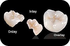 Incrustación de cerámica inlay.