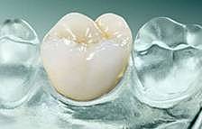 Coronas de ceramica