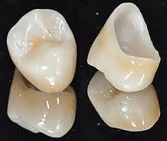 Fabricacion de primera corona de porcelana totalmente cerámica